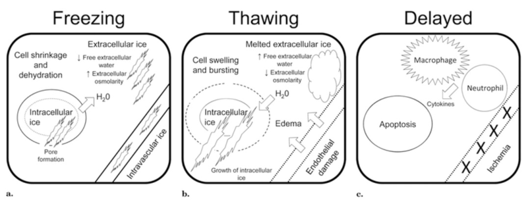 腫瘤治療界的「高冷之花」——腫瘤微創(chuàng)冷凍消融，國產替代設備空間巨大