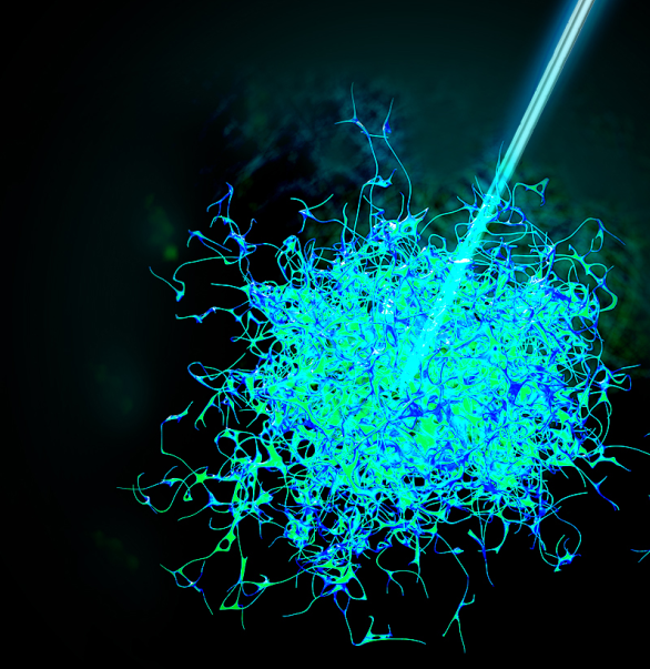 今天，我們把腫瘤的內部「融穿」了